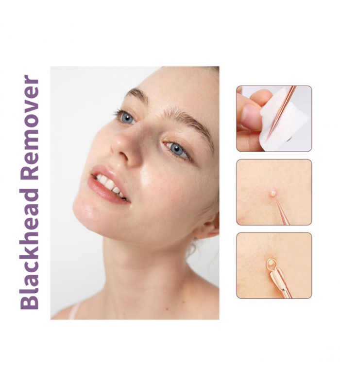 Інструменти косметичні для видалення вугрів MODAY_https://pinklab.com.ua